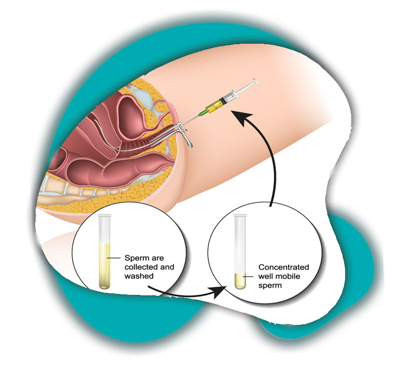 IVF (In Vitro Fertilisation) dr meenu bhanot